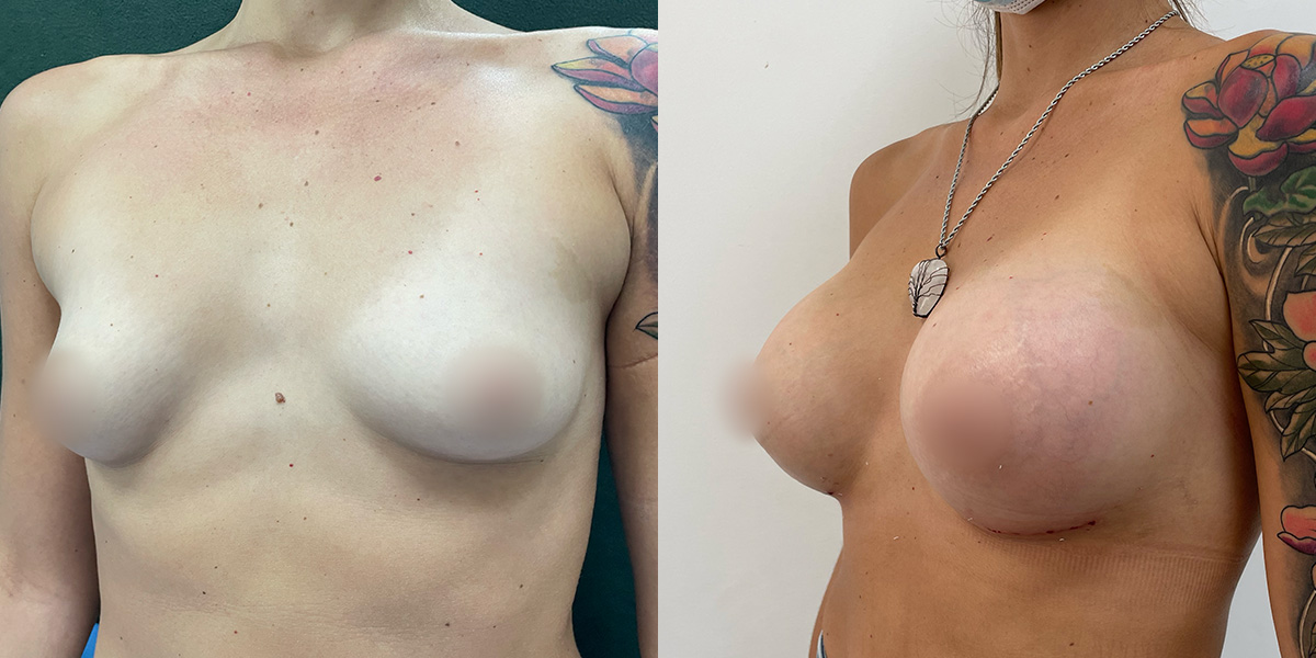 Breast Augmentation Before & After Gallery - Patient 55793687 - Image 3