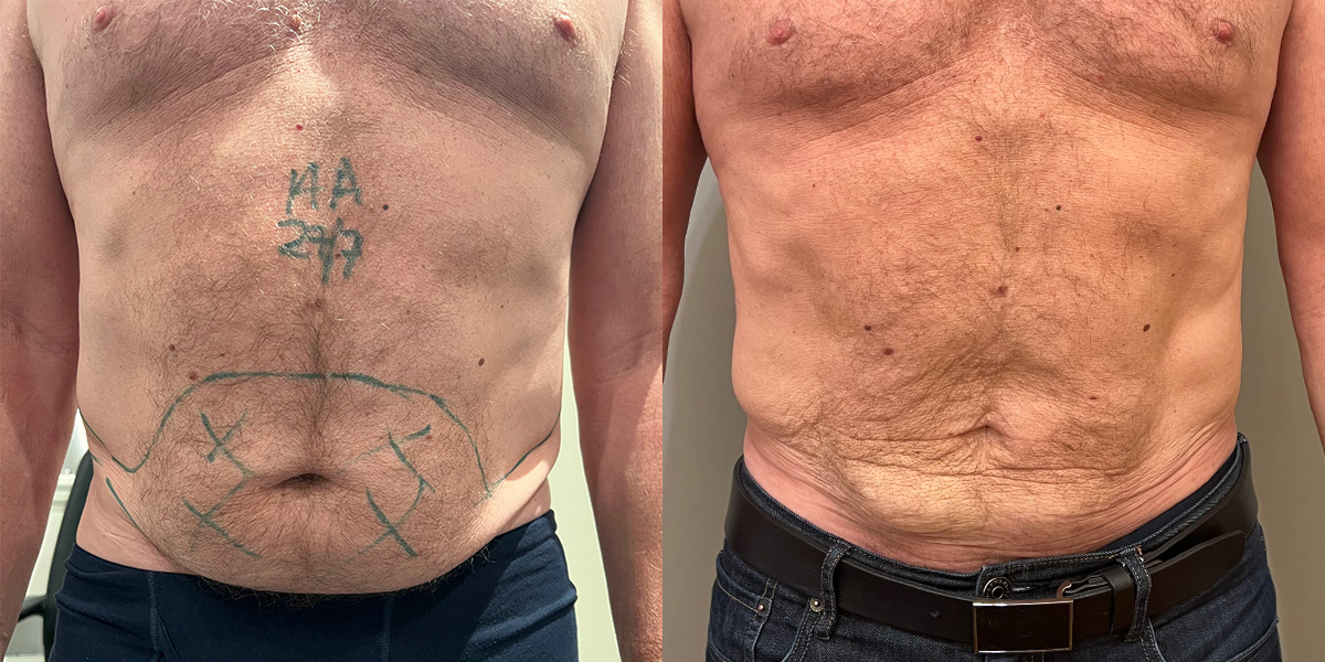 Liposuction Before & After Gallery - Patient 55793693 - Image 1