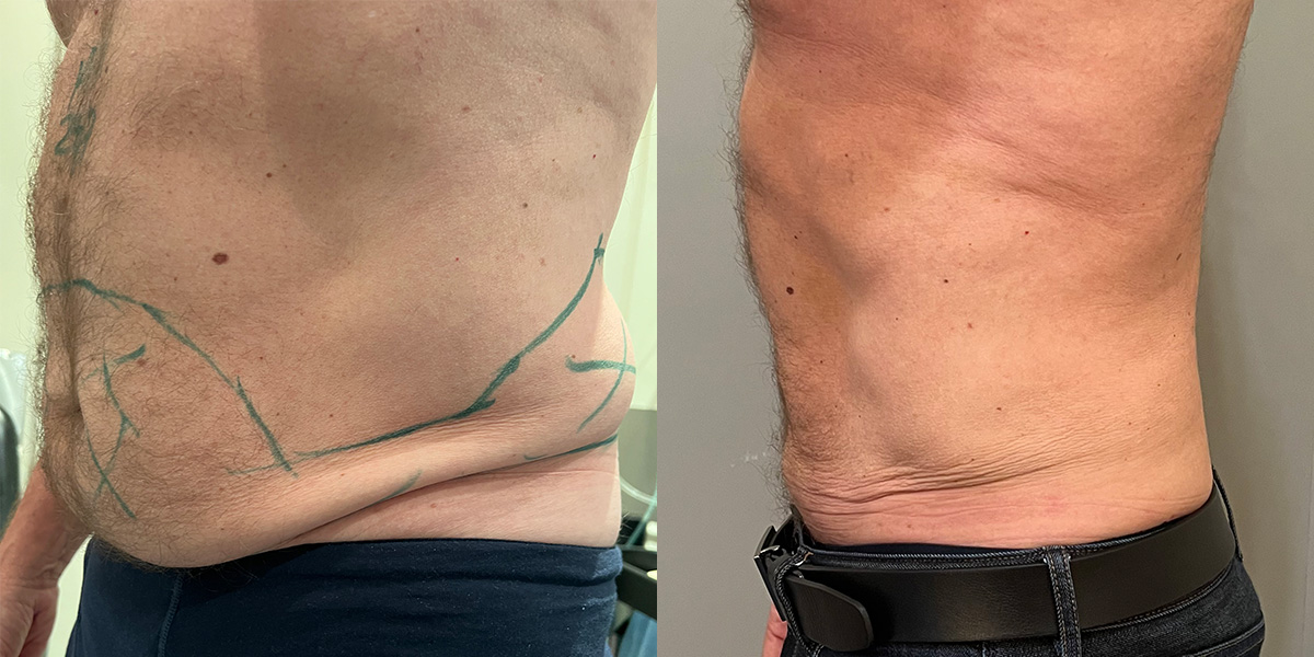 Liposuction Before & After Gallery - Patient 55793693 - Image 3