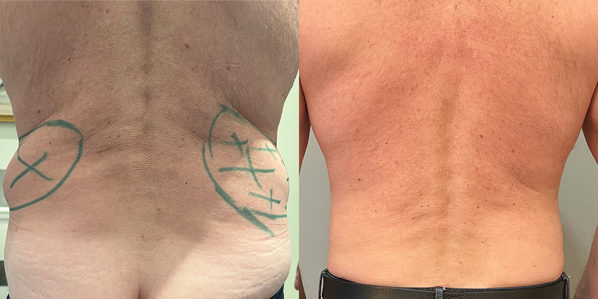 Liposuction Before & After Gallery - Patient 55793693 - Image 4