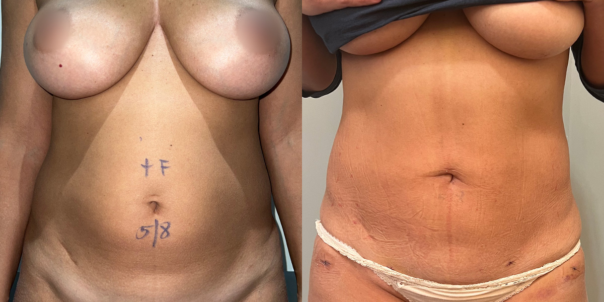 Before & After Liposuction