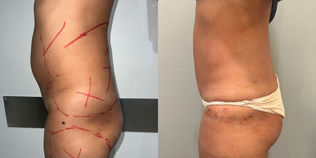 Liposuction Before & After Gallery - Patient 55793694 - Image 2