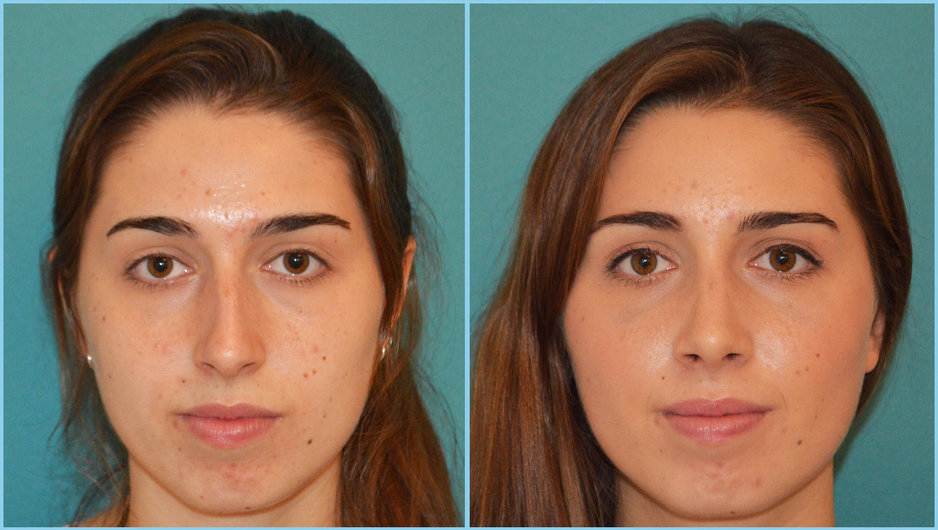 Rhinoplasty Before & After Gallery - Patient 55959447 - Image 2