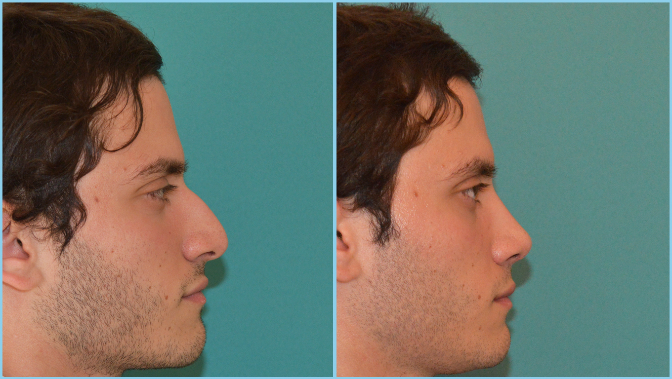 Rhinoplasty Before & After Gallery - Patient 55959445 - Image 1