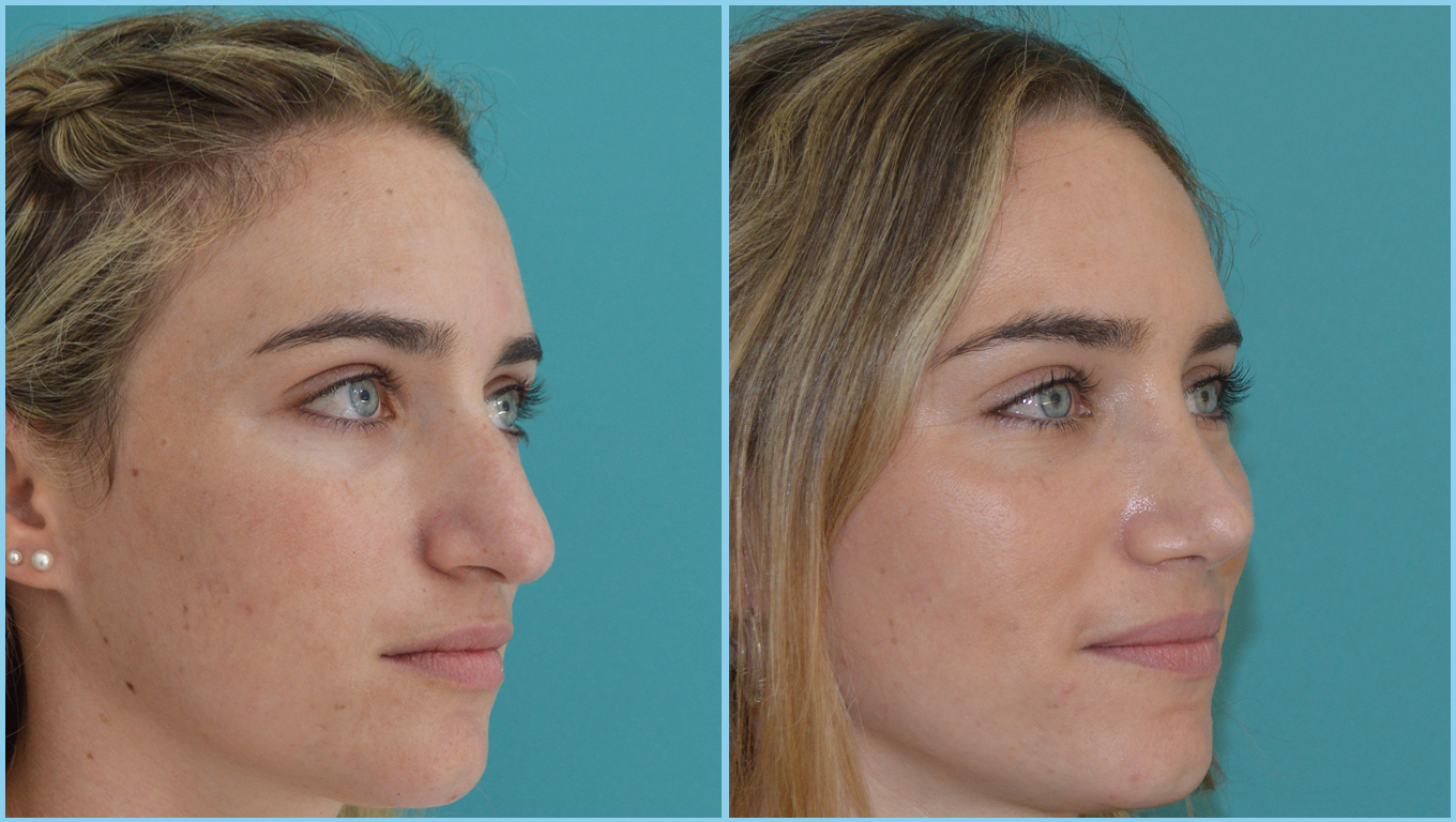Rhinoplasty Before & After Gallery - Patient 55959449 - Image 3