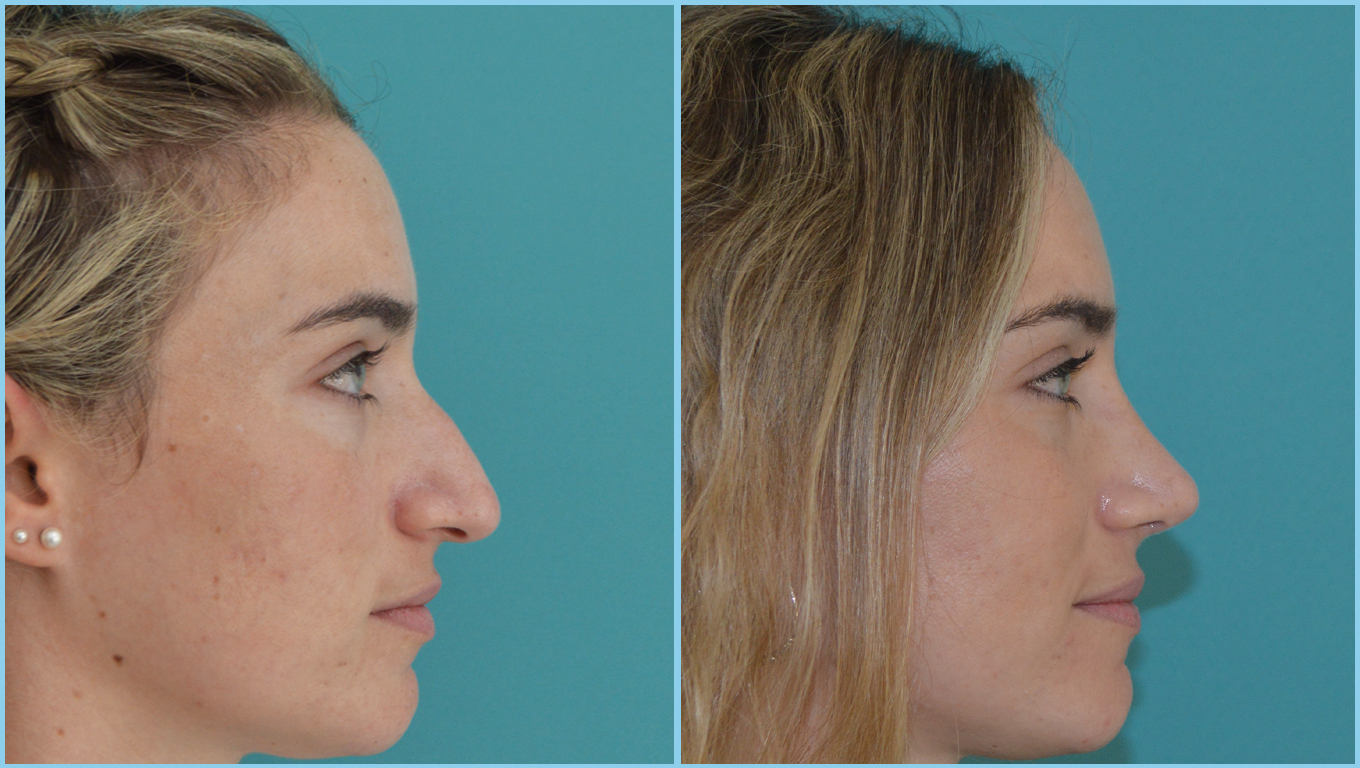 Rhinoplasty Before & After Gallery - Patient 55959449 - Image 1