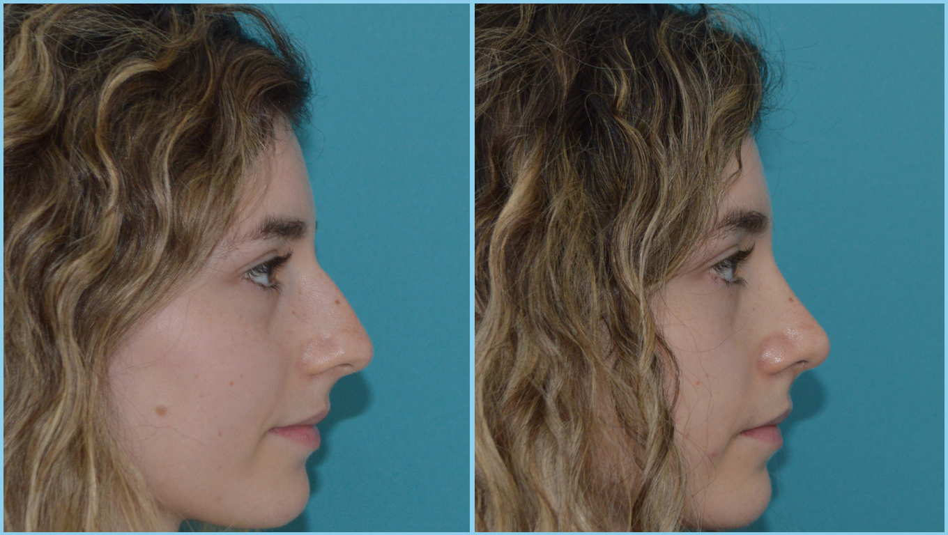 Rhinoplasty Before & After Gallery - Patient 55959451 - Image 1