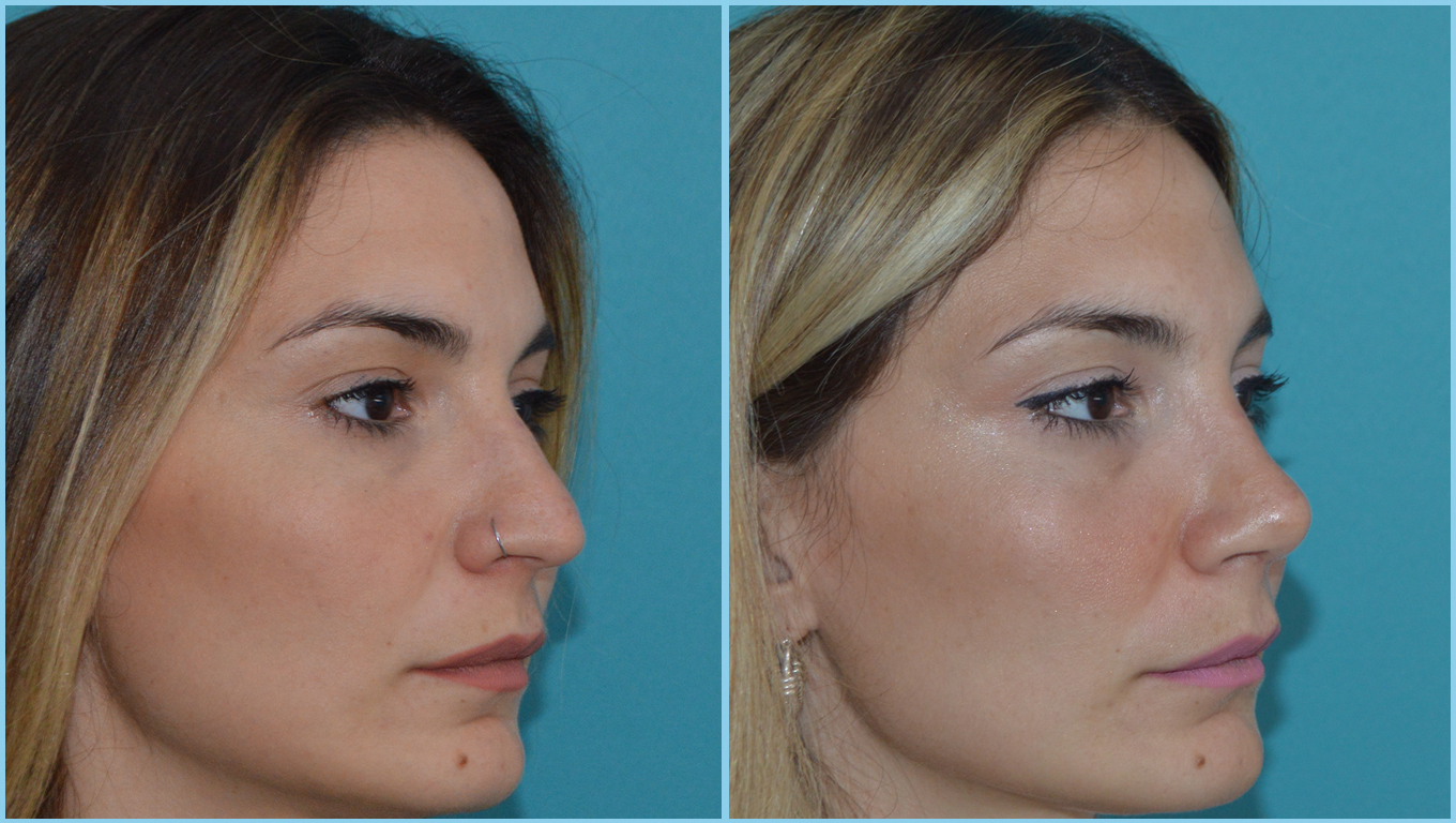 Rhinoplasty Before & After Gallery - Patient 55959452 - Image 3