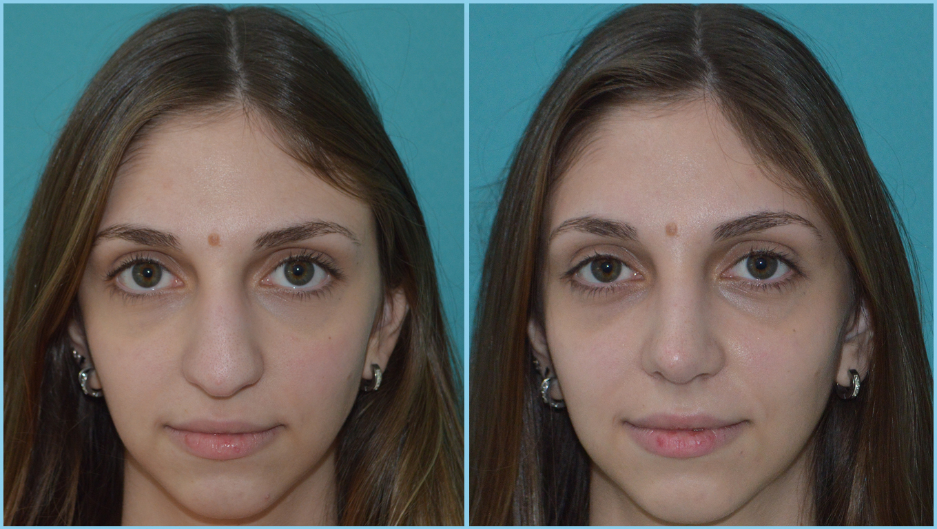Rhinoplasty Before & After Gallery - Patient 55959453 - Image 2