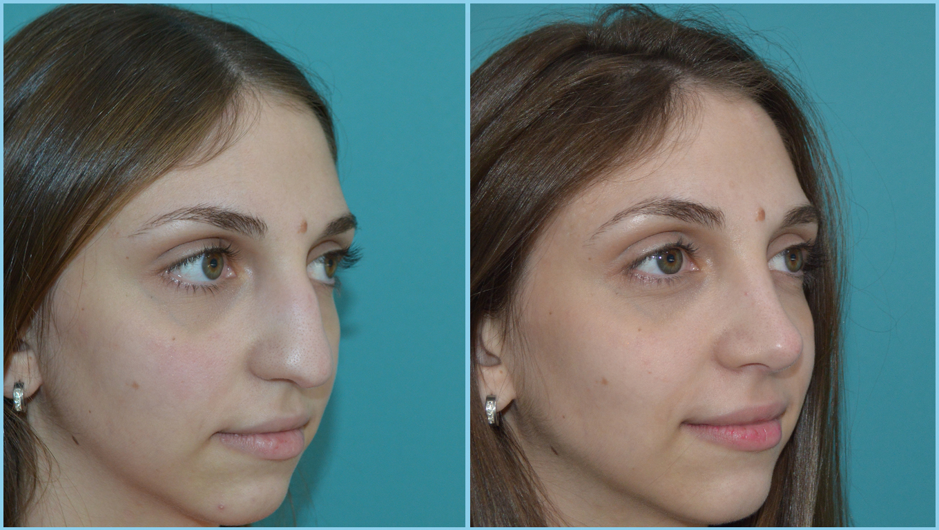 Rhinoplasty Before & After Gallery - Patient 55959453 - Image 3