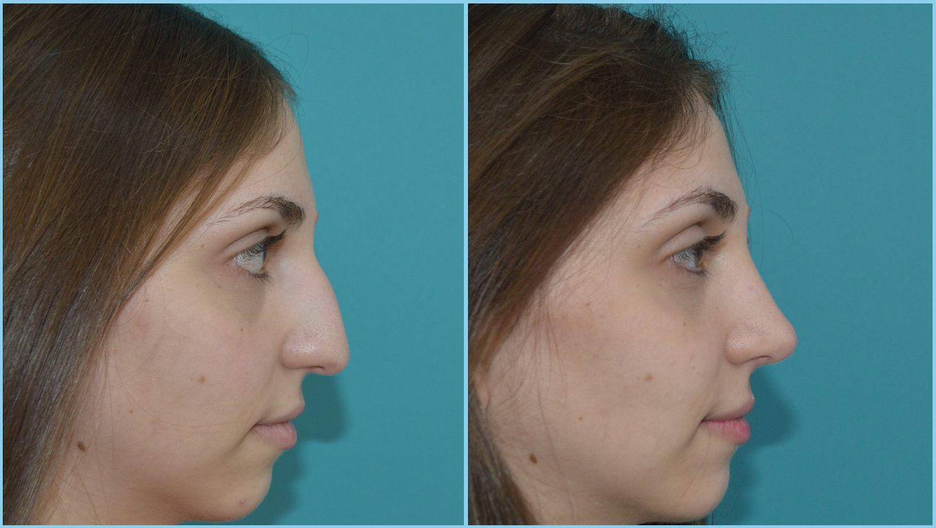 Rhinoplasty Before & After Gallery - Patient 55959453 - Image 1