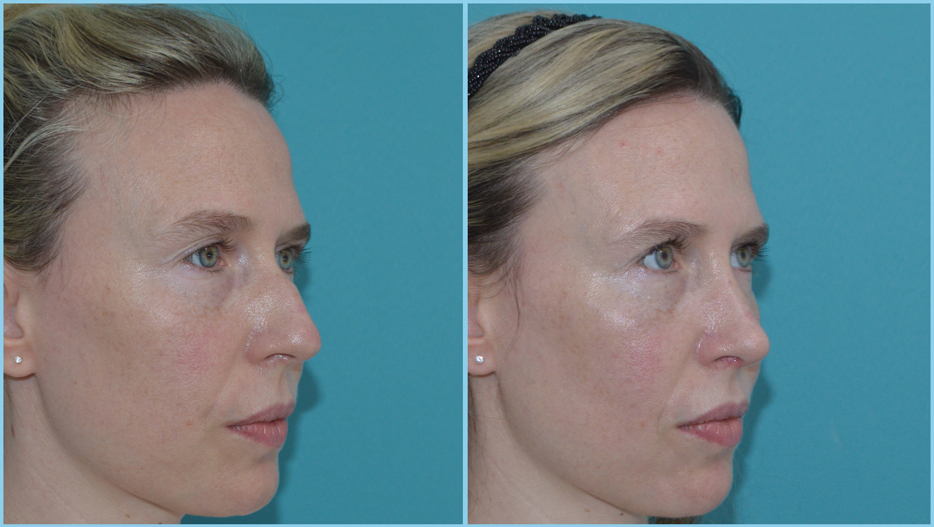 Rhinoplasty Before & After Gallery - Patient 55959455 - Image 2