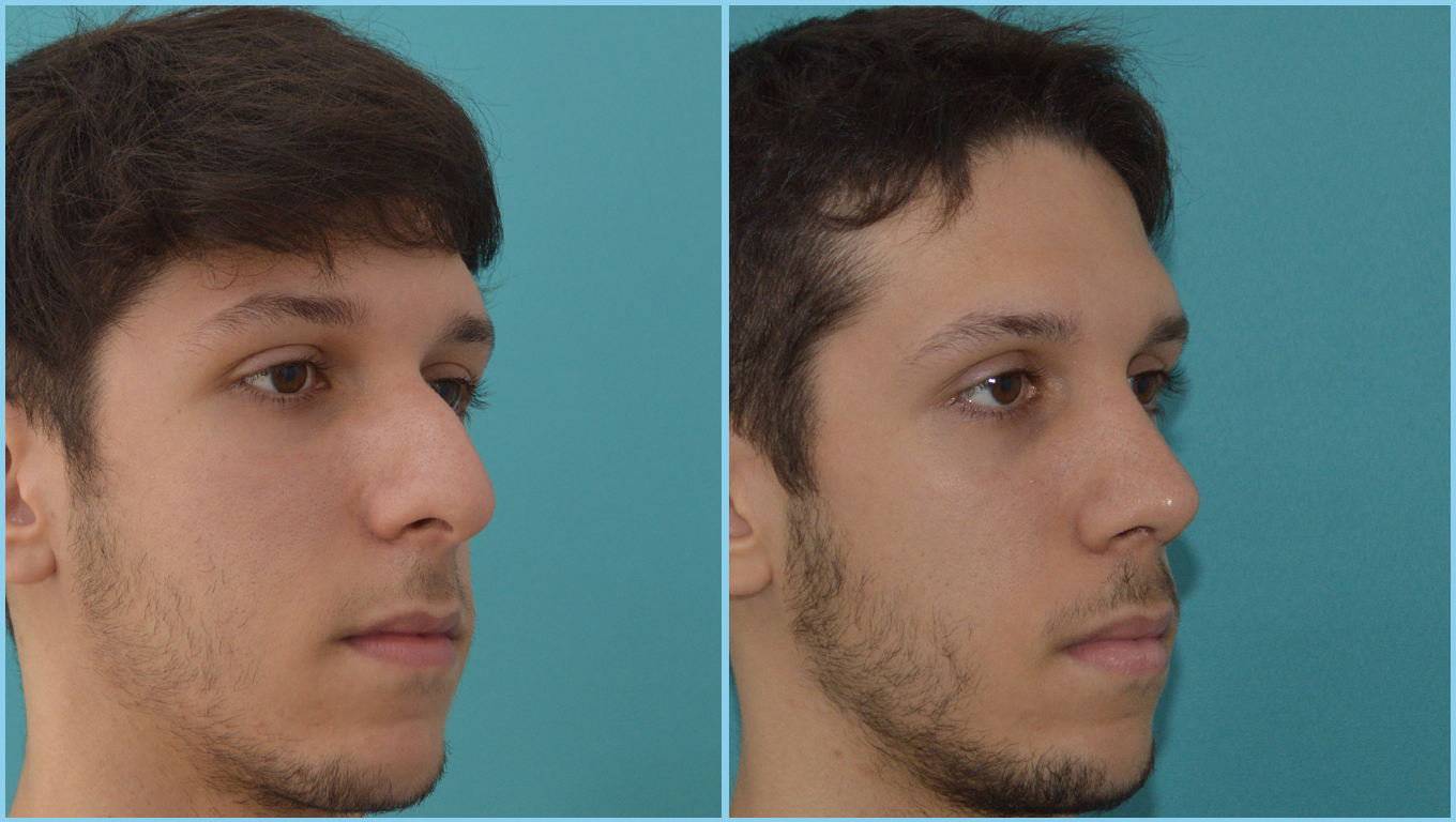 Rhinoplasty Before & After Gallery - Patient 55959456 - Image 3