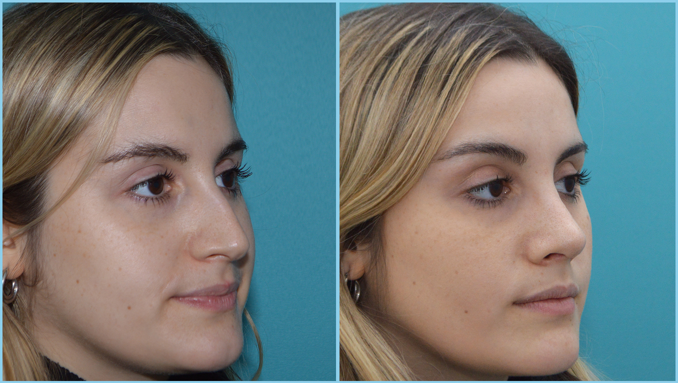 Rhinoplasty Before & After Gallery - Patient 55959458 - Image 2