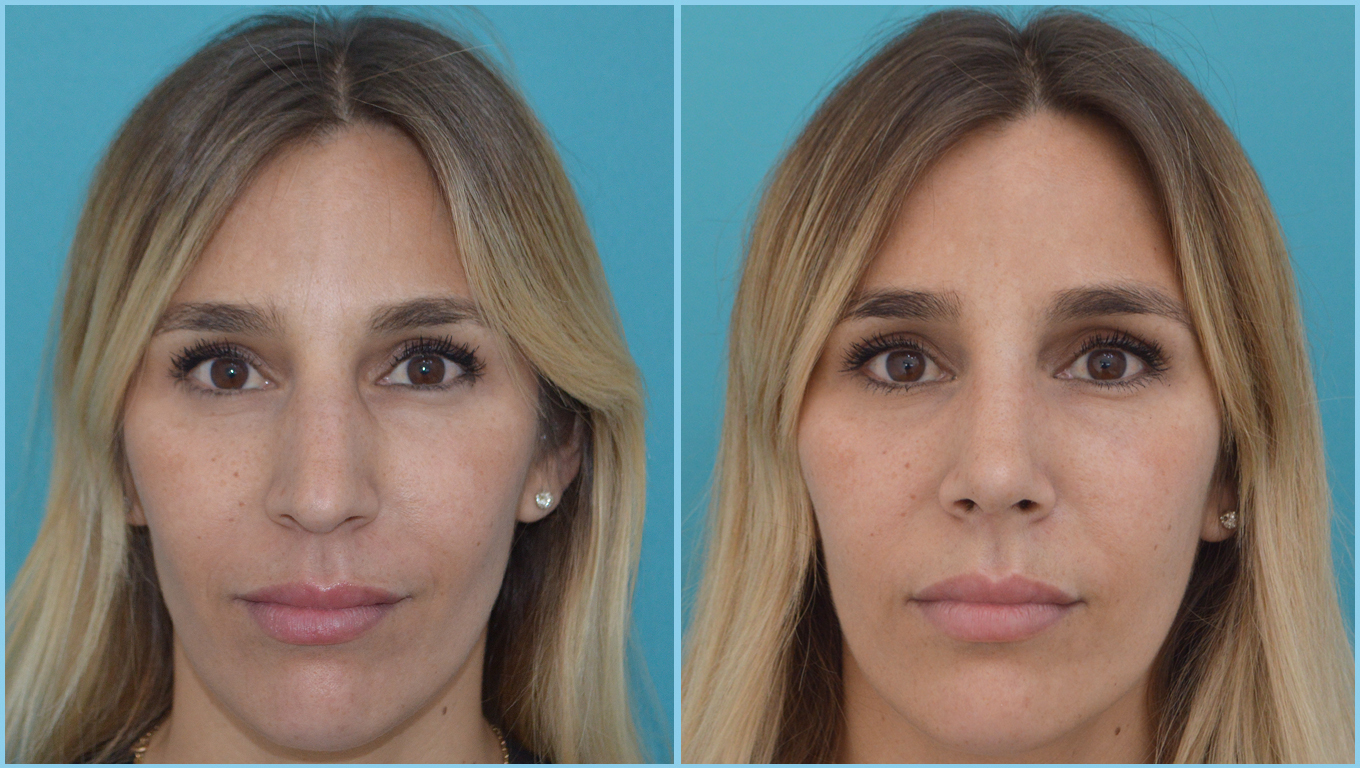 Rhinoplasty Before & After Gallery - Patient 55959459 - Image 2