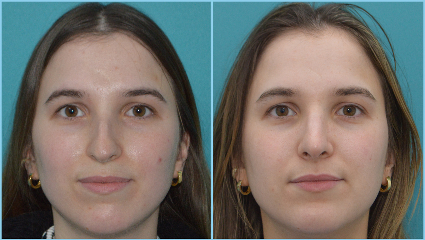 Rhinoplasty Before & After Gallery - Patient 55959460 - Image 2