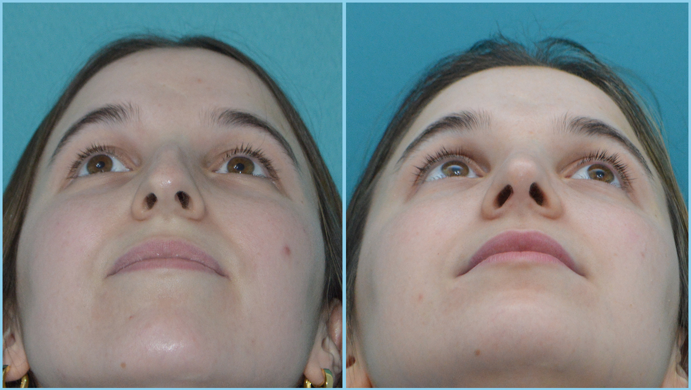 Rhinoplasty Before & After Gallery - Patient 55959460 - Image 4