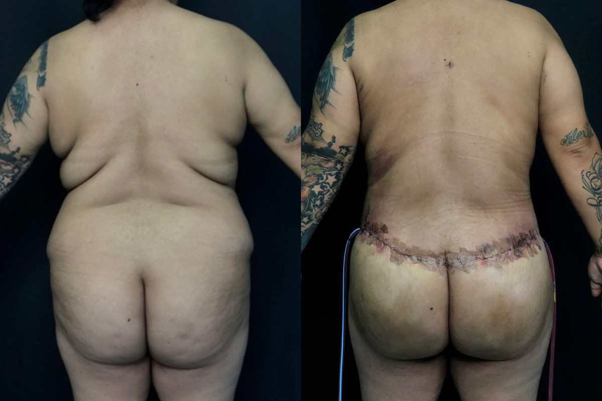 Mommy Makeover Before & After Gallery - Patient 56112280 - Image 1