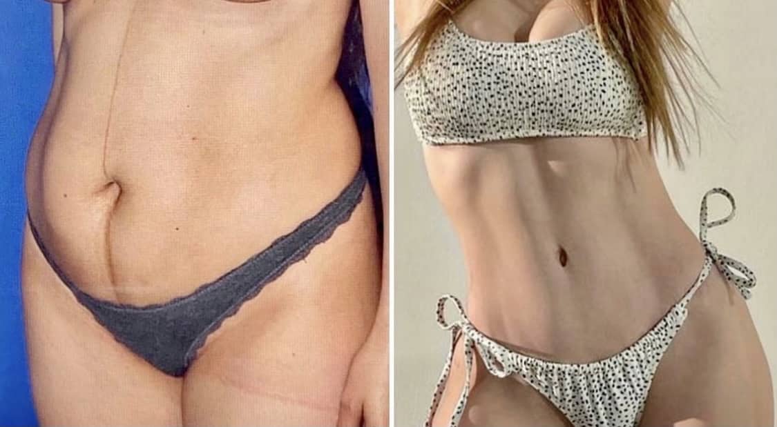 Before & After Tummy Tuck