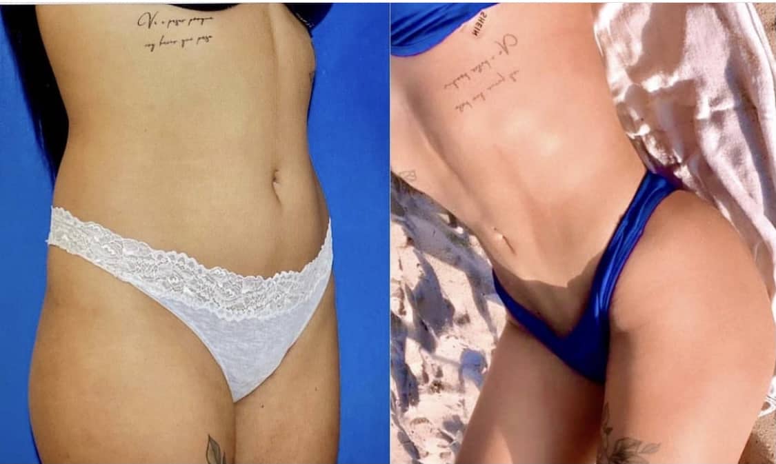 Tummy Tuck Before & After Gallery - Patient 63244649 - Image 1