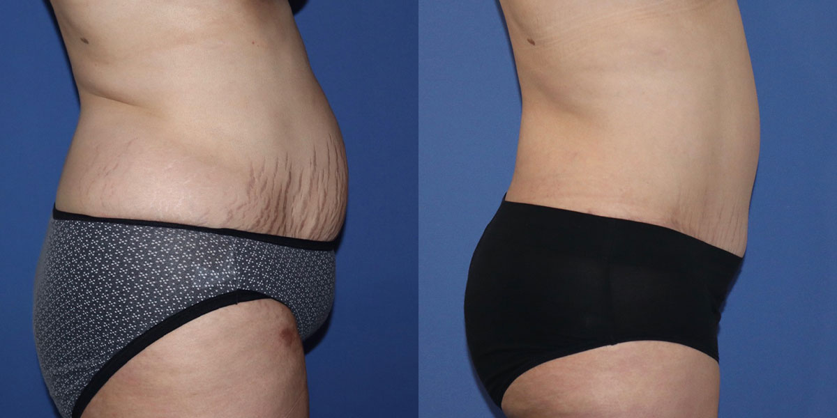 Tummy Tuck Before & After Gallery - Patient 63244657 - Image 5