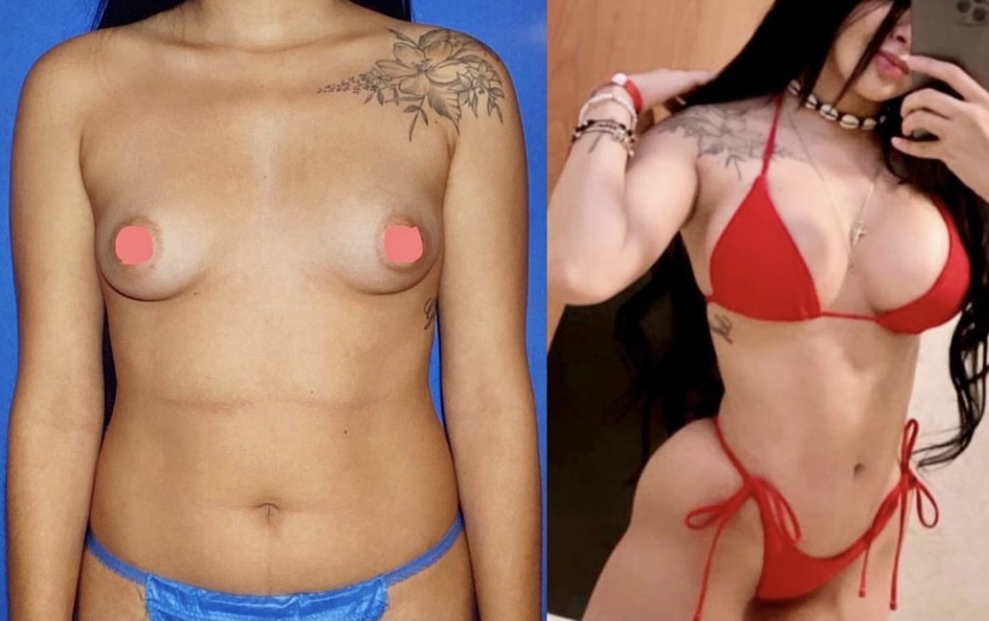 Breast Augmentation Before & After Gallery - Patient 63244696 - Image 1