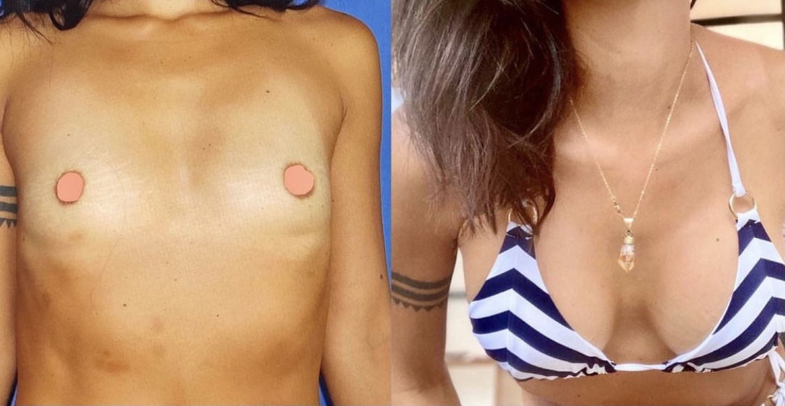 Breast Augmentation Before & After Gallery - Patient 63244697 - Image 1