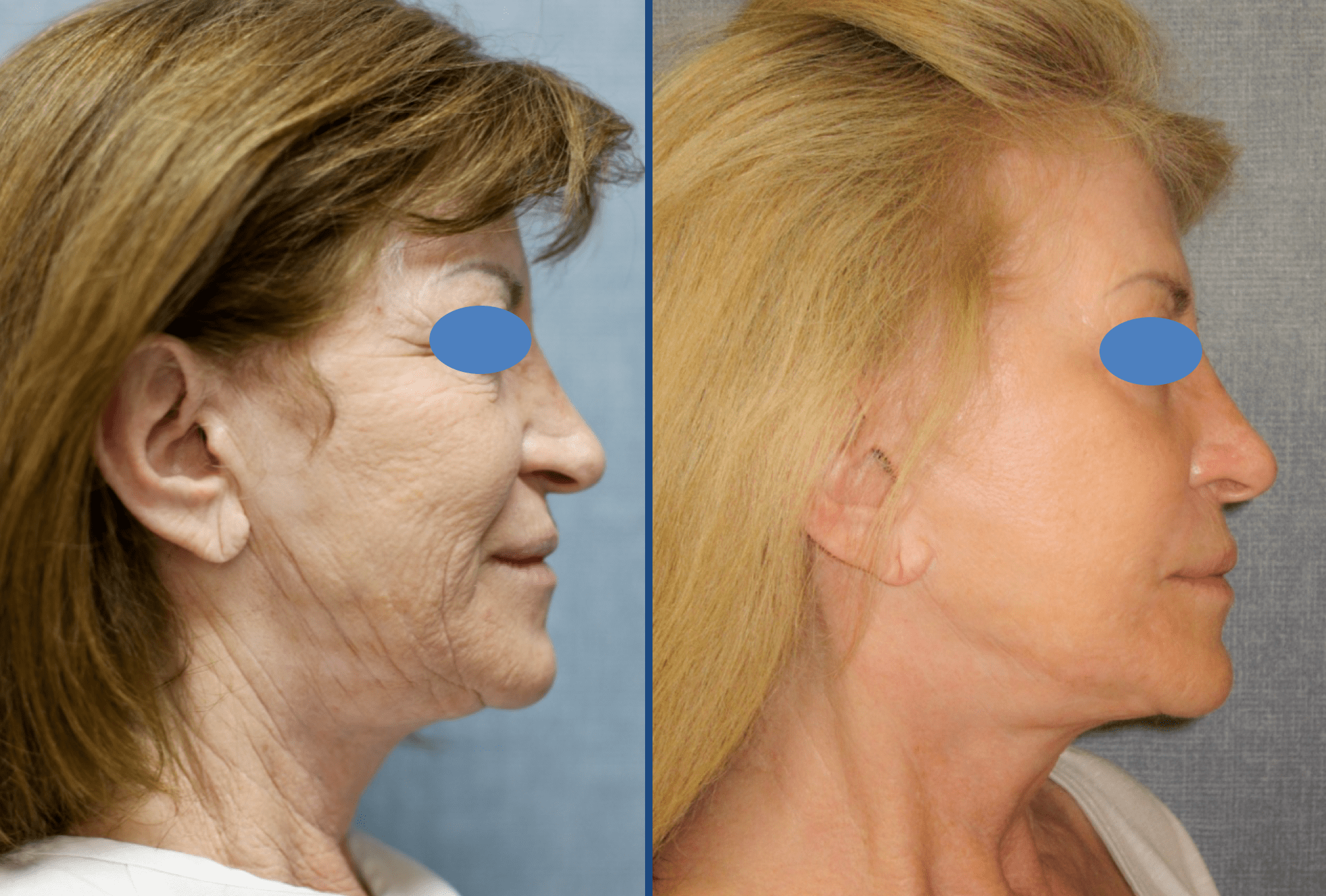 Facelift Before & After Gallery - Patient 63244743 - Image 1