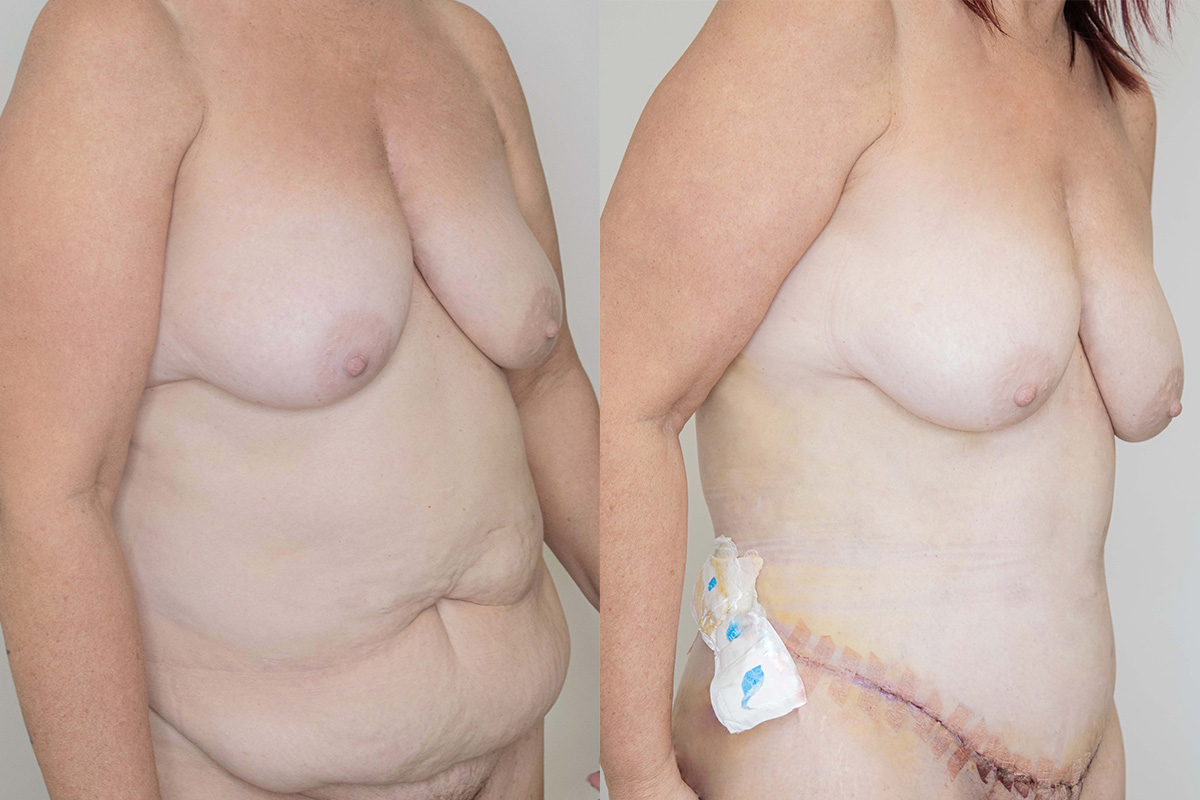 Liposuction Before & After Gallery - Patient 64084026 - Image 2