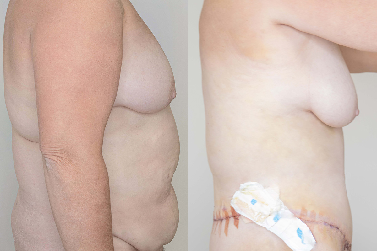 Liposuction Before & After Gallery - Patient 64084026 - Image 3