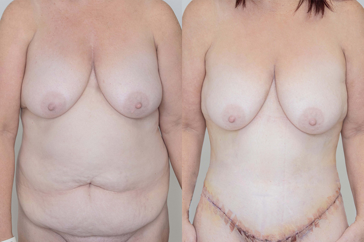 Liposuction Before & After Gallery - Patient 64084026 - Image 1