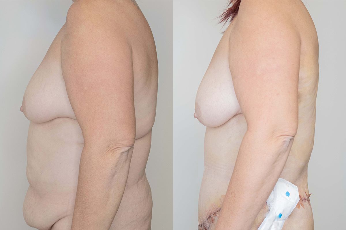 Liposuction Before & After Gallery - Patient 64084026 - Image 4