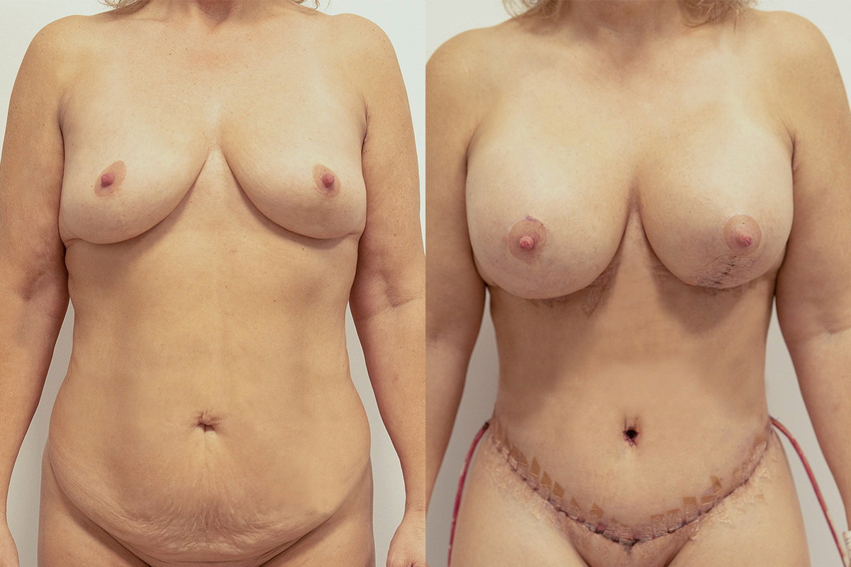 Liposuction Before & After Gallery - Patient 64084043 - Image 1