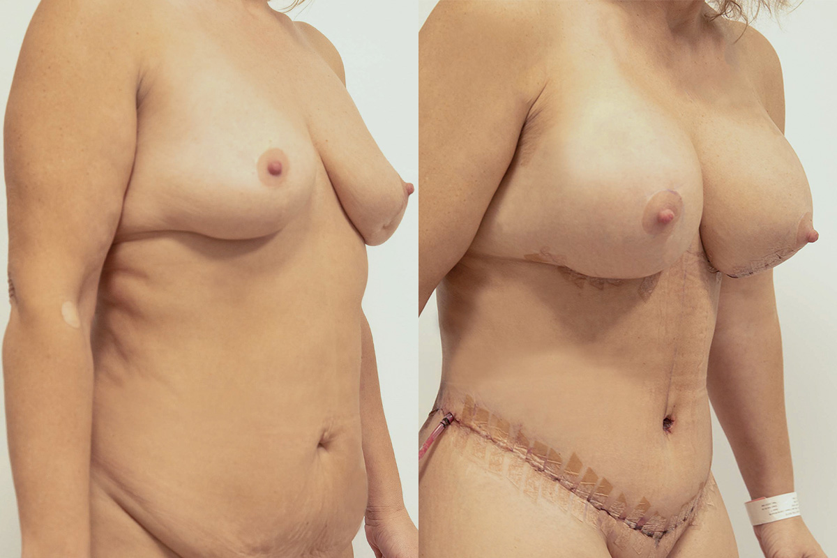 Liposuction Before & After Gallery - Patient 64084043 - Image 2