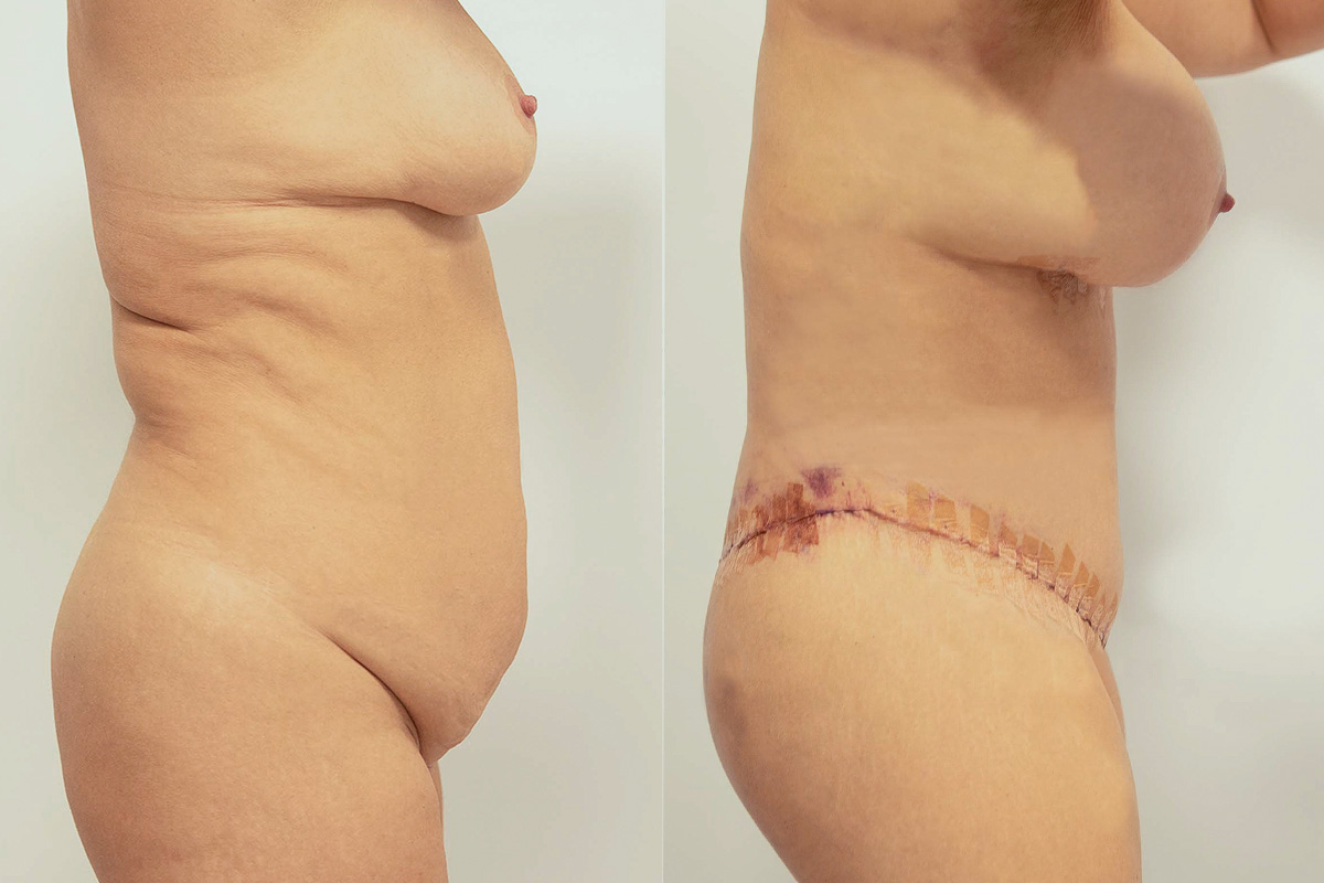 Liposuction Before & After Gallery - Patient 64084043 - Image 3