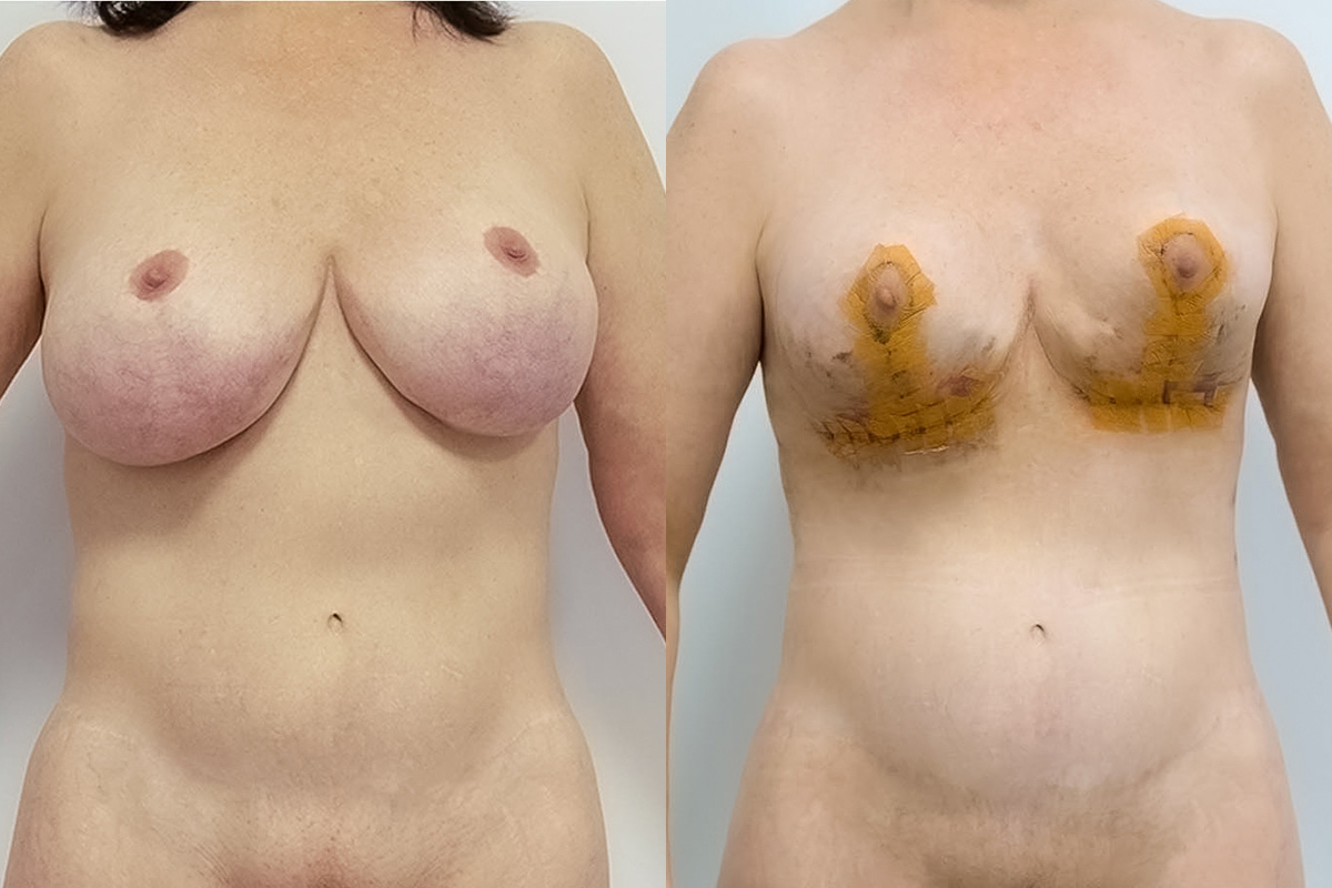 Breast Lift Before & After Gallery - Patient 64084064 - Image 1