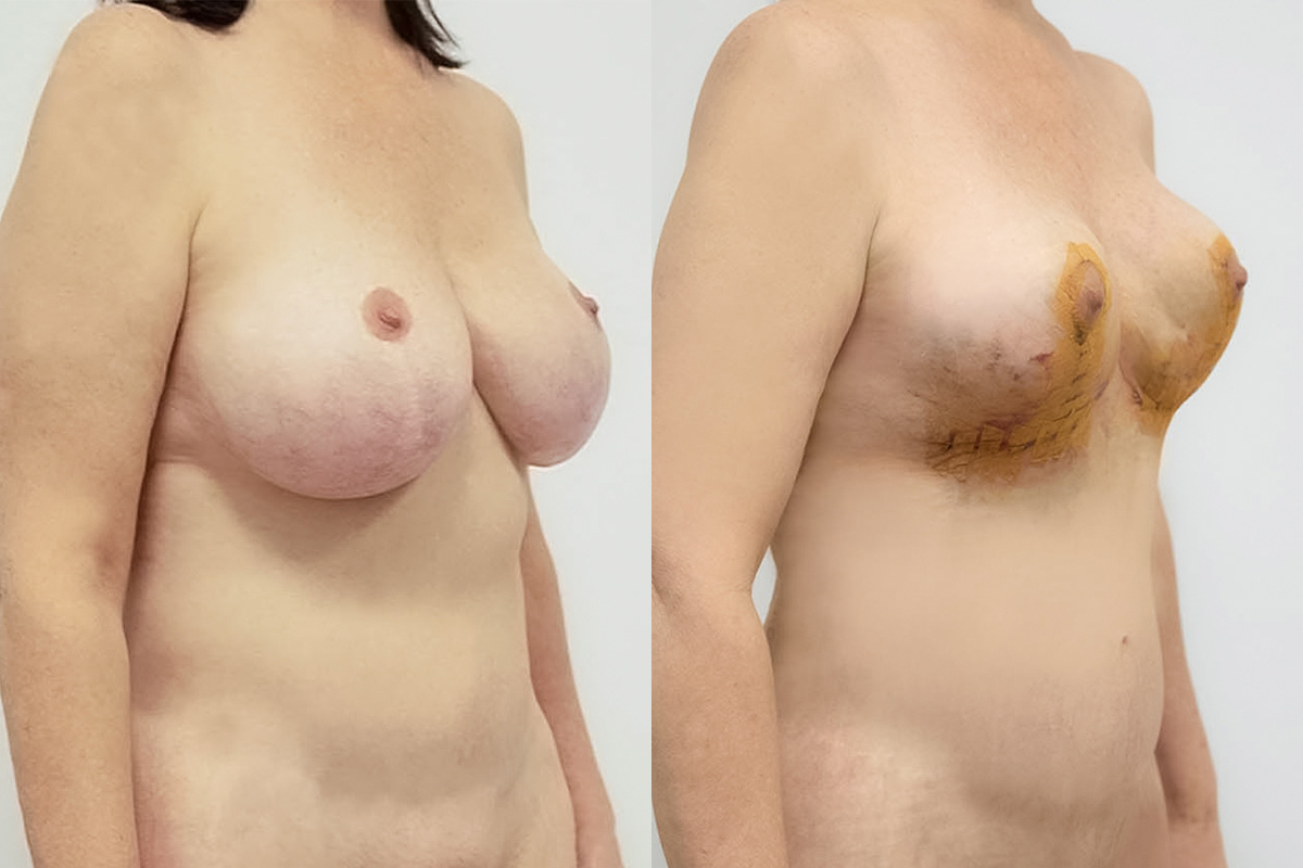 Liposuction Before & After Gallery - Patient 64084069 - Image 2