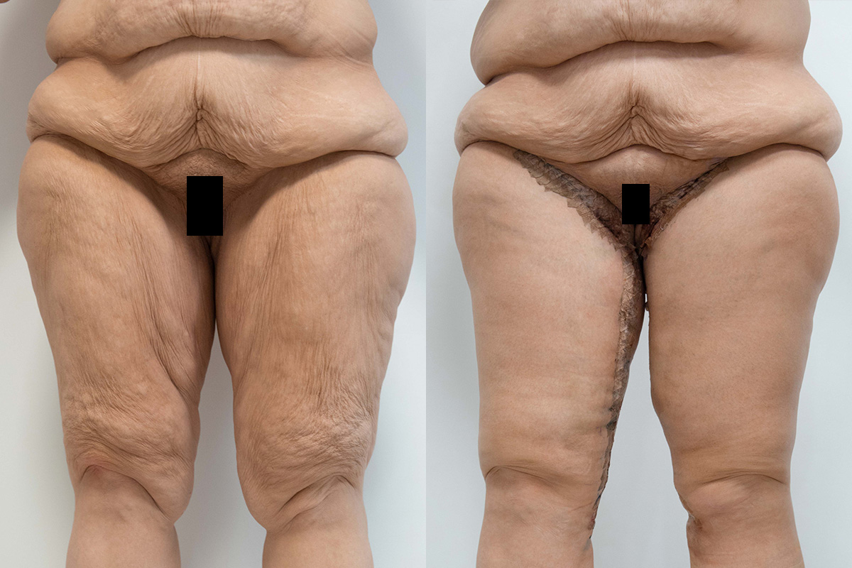 Liposuction Before & After Gallery - Patient 64084209 - Image 1
