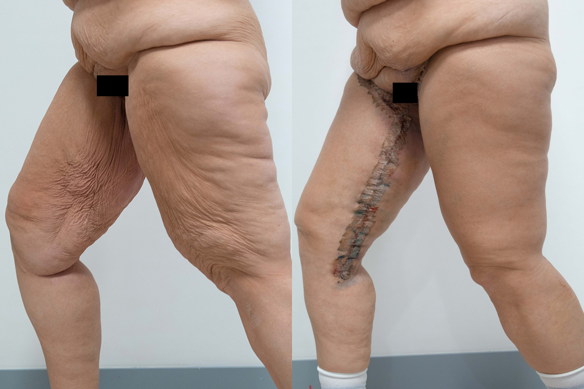 Body Lift Before & After Gallery - Patient 64084210 - Image 3