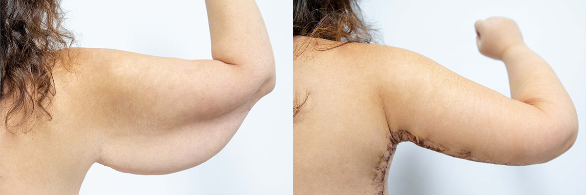 Body Lift Before & After Gallery - Patient 64084210 - Image 4