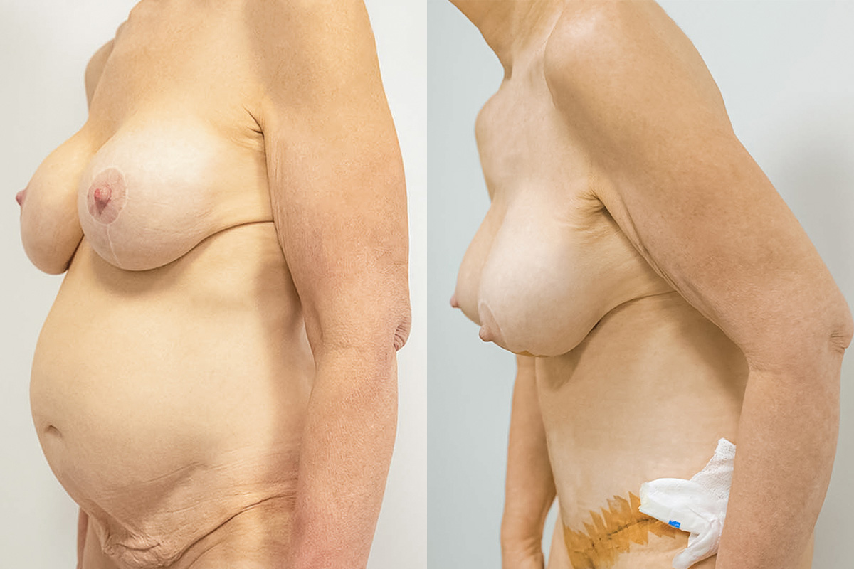 Liposuction Before & After Gallery - Patient 64084225 - Image 2