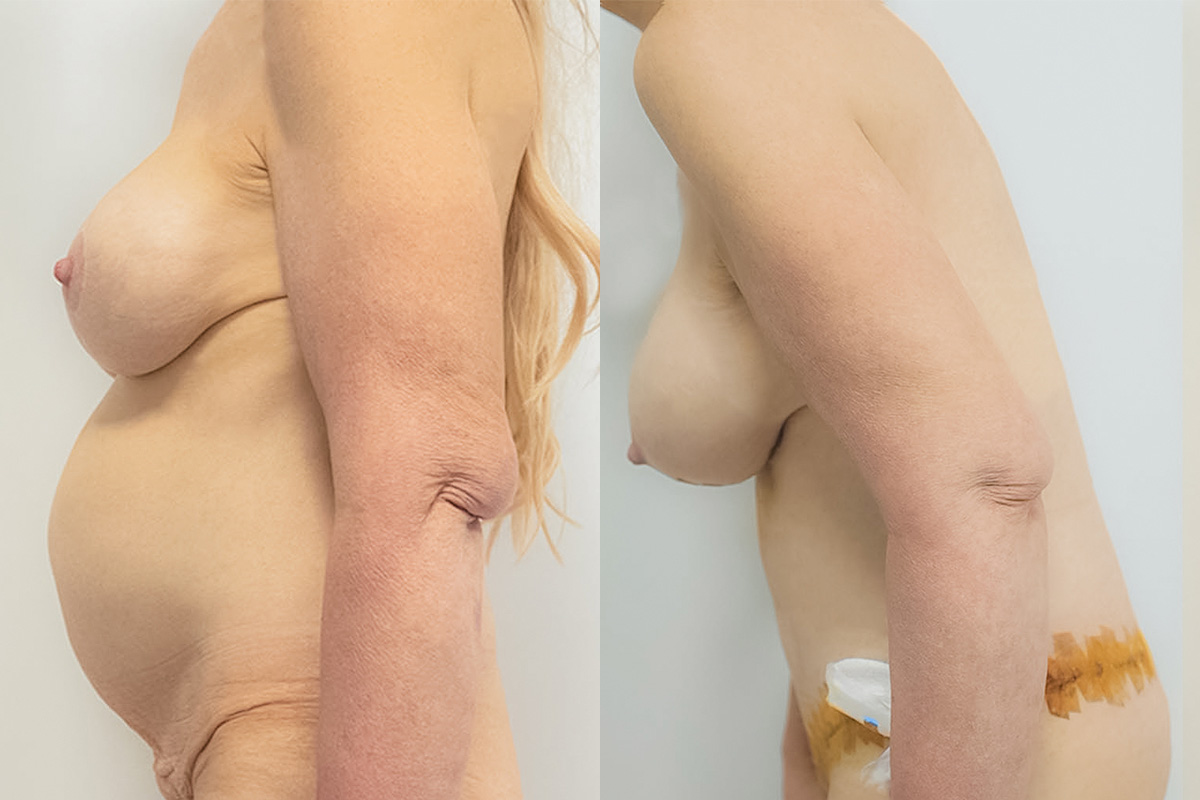 Breast Lift with Implant Exchange Before & After Gallery - Patient 64084227 - Image 3