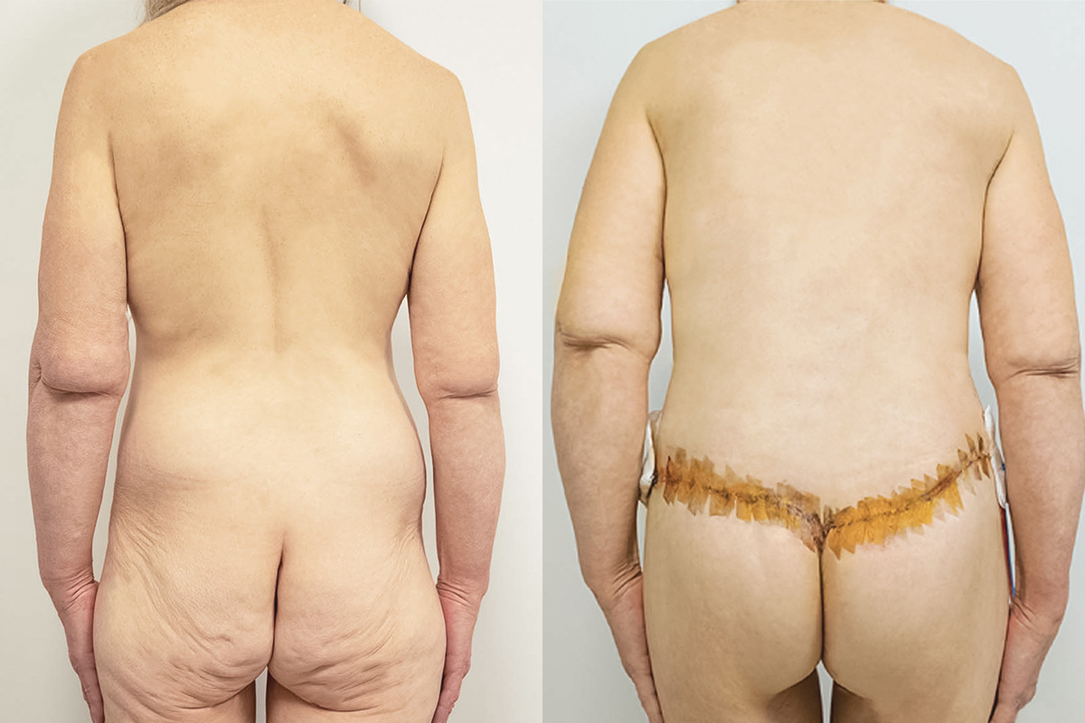 Breast Lift with Implant Exchange Before & After Gallery - Patient 64084227 - Image 5