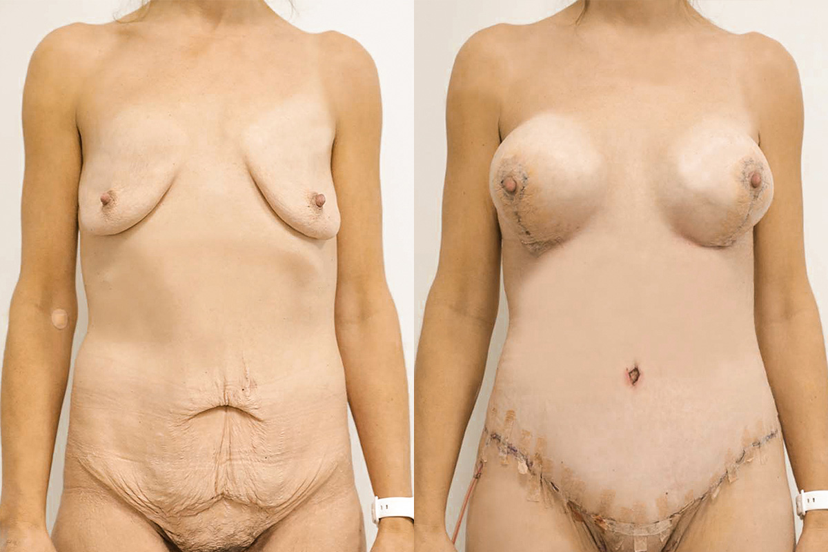 Tummy Tuck Before & After Gallery - Patient 64084229 - Image 1