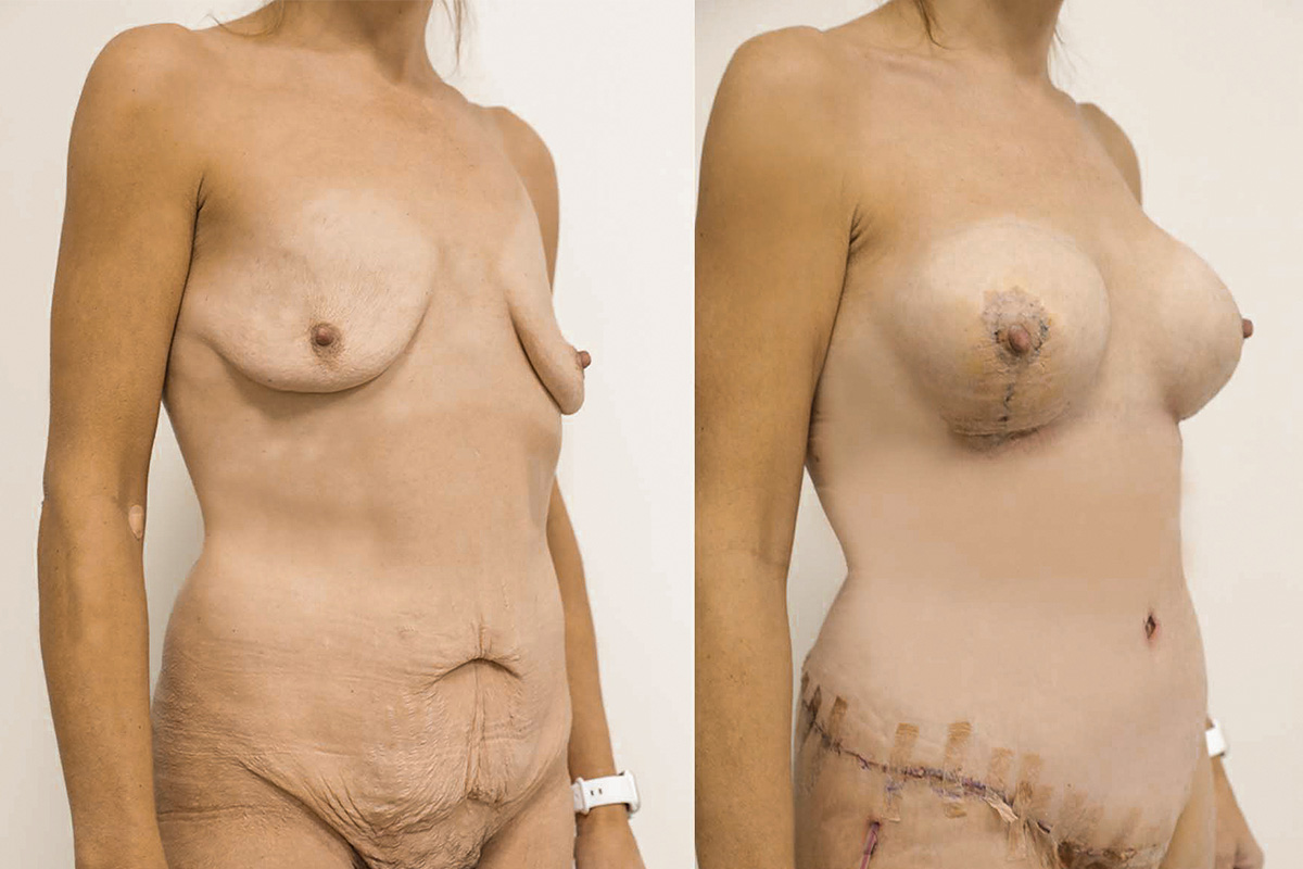Tummy Tuck Before & After Gallery - Patient 64084229 - Image 2