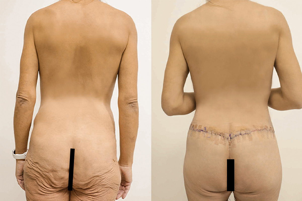 Tummy Tuck Before & After Gallery - Patient 64084229 - Image 3
