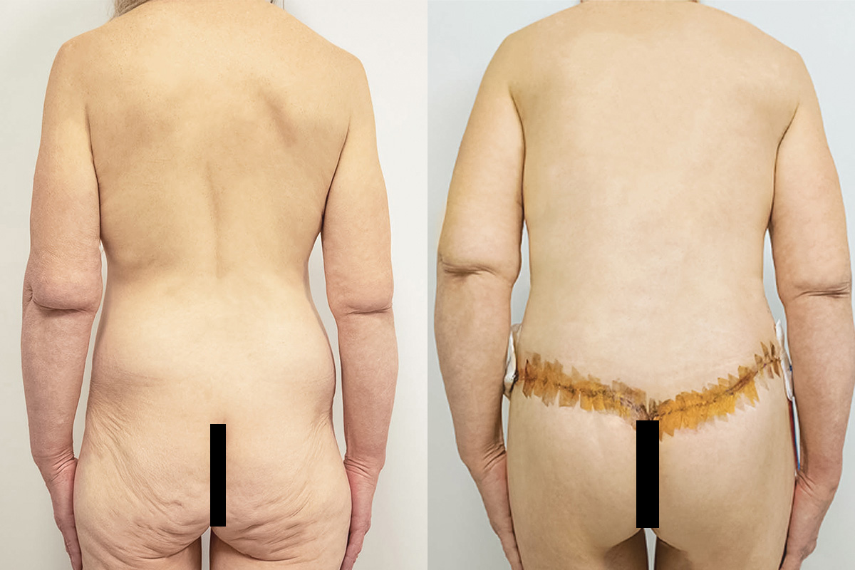 Liposuction Before & After Gallery - Patient 64084225 - Image 5