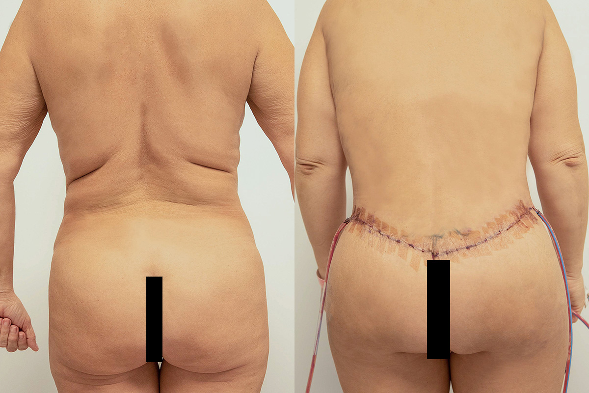 Tummy Tuck Before & After Gallery - Patient 64084044 - Image 5