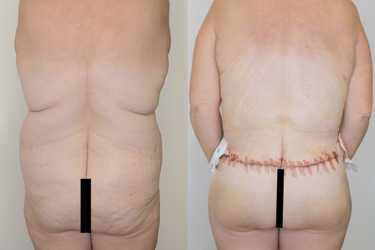 Tummy Tuck Before & After Gallery - Patient 64084025 - Image 5
