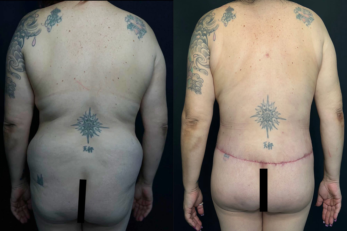Tummy Tuck Before & After Gallery - Patient 56112183 - Image 1